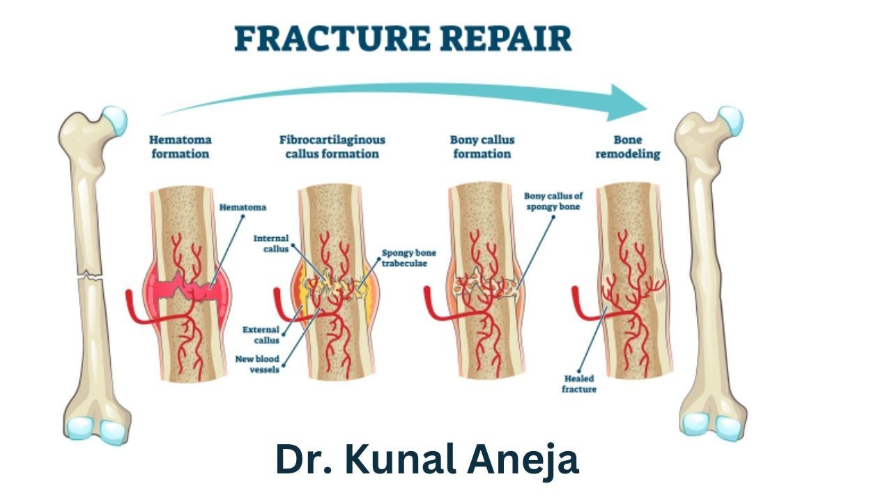 Bone Fracture Treatment – Dr Kunal Aneja